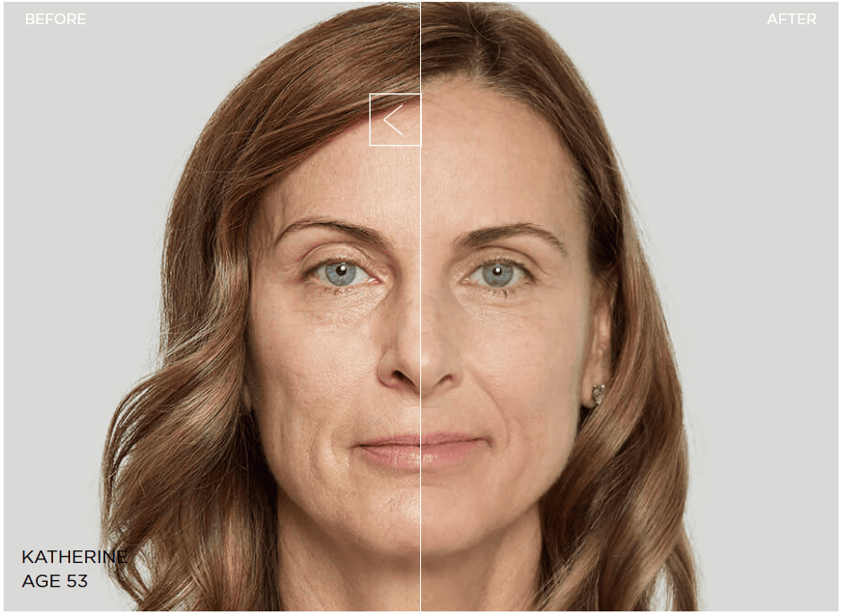 Before and After with Sculptra